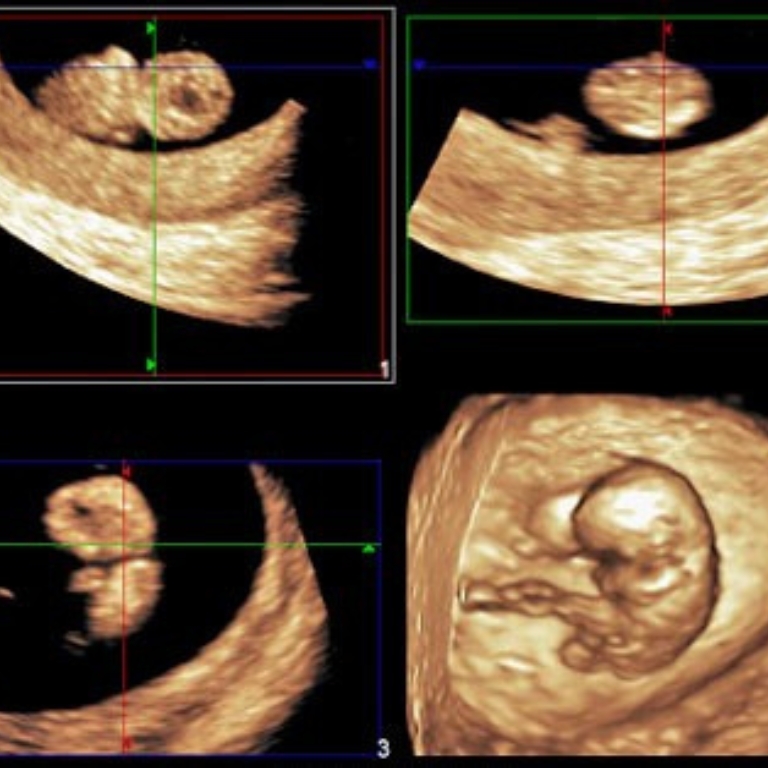 Mehrere Ultraschallbilder zeigen den Embryo in der 12. Schwangerschaftswoche aus verschiedenen Perspektiven.
