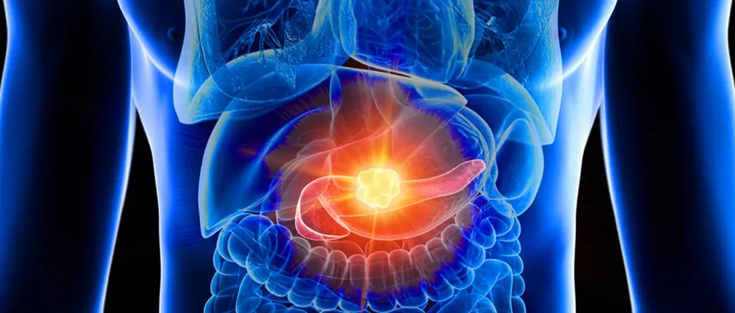 Illustration des menschlichen Oberkörpers mit transparent dargestellten inneren Organen. Die Bauchspeicheldrüse (Pankreas) ist rosa hervorgehoben und zeigt im Zentrum einen hell leuchtenden, gelb-weißen Tumor, der auf Bauchspeicheldrüsenkrebs hinweist. Die umliegenden Organe wie Leber, Magen und Darm sind schematisch in Blautönen dargestellt.
