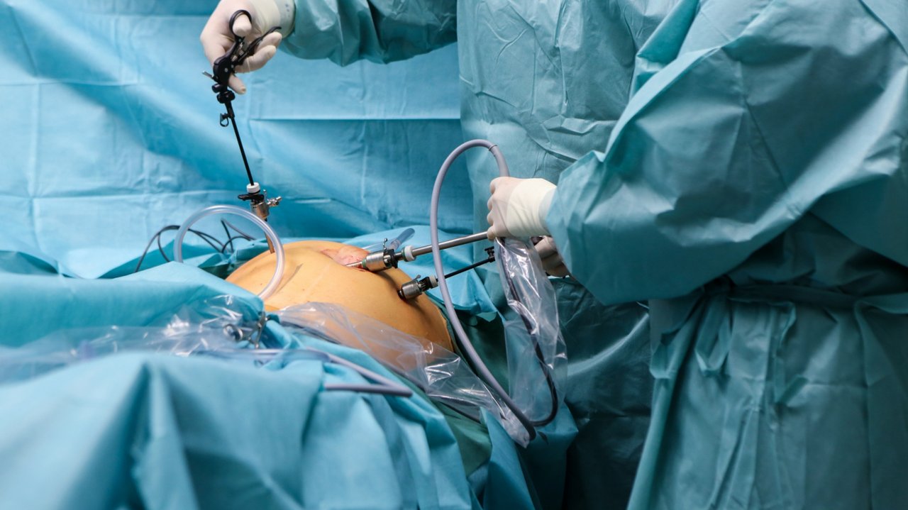 Laparoskopische OP im Bauchraum