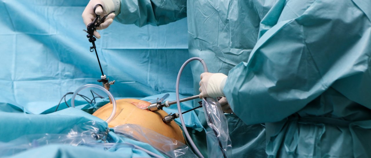 Laparoskopische OP im Bauchraum