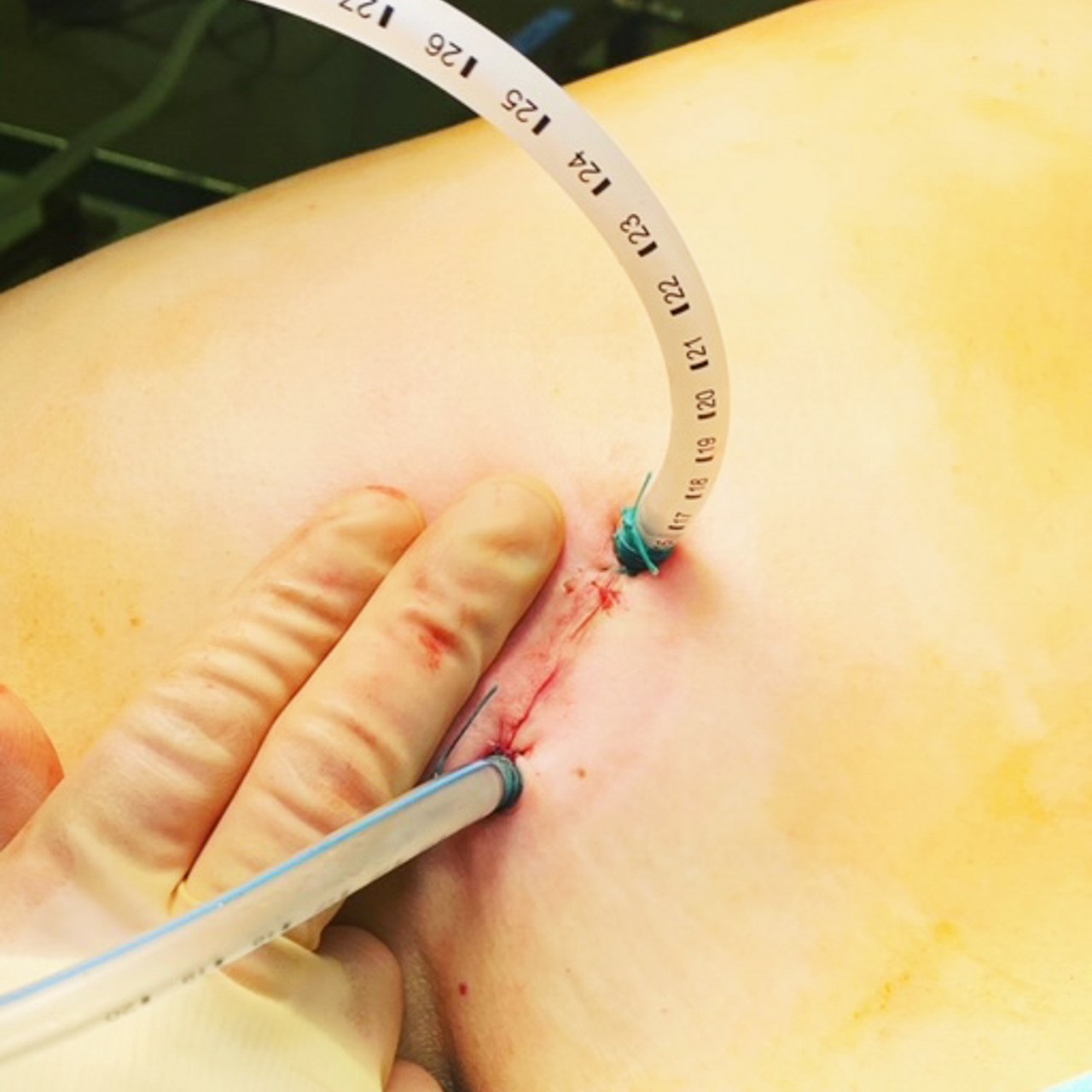 Ein Thorax der frisch in eine Lunge operiert wurde