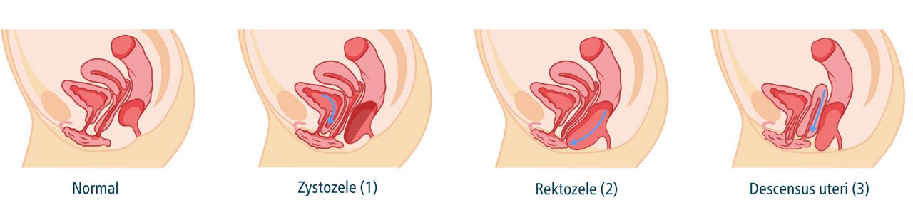 Grafik zur Beckenbodensenkung, Normal, Zystozele (1), Rektozele (2), Descensus uteri (3)