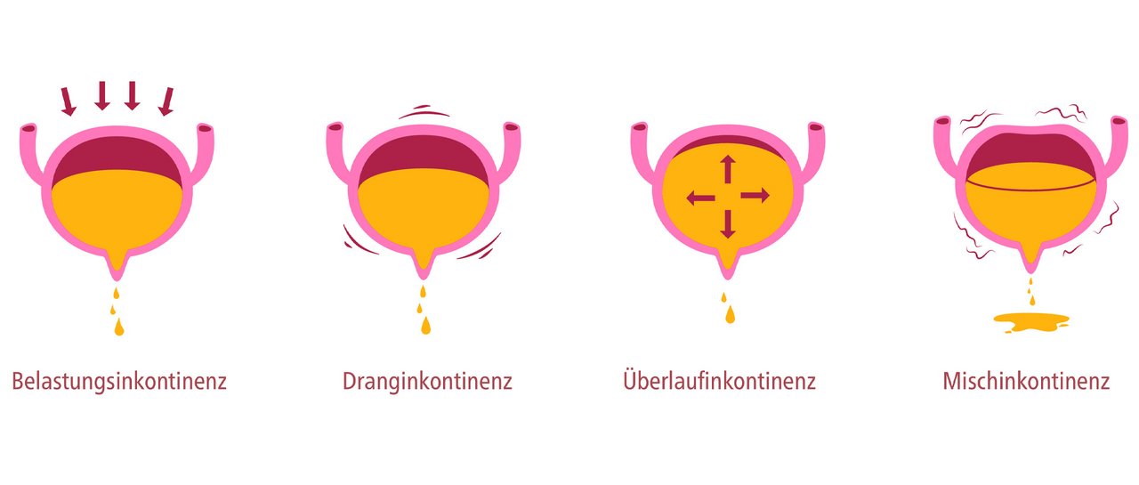 Eine Grafik zur Erläuterung verschiedener Arten von Inkontinenz
