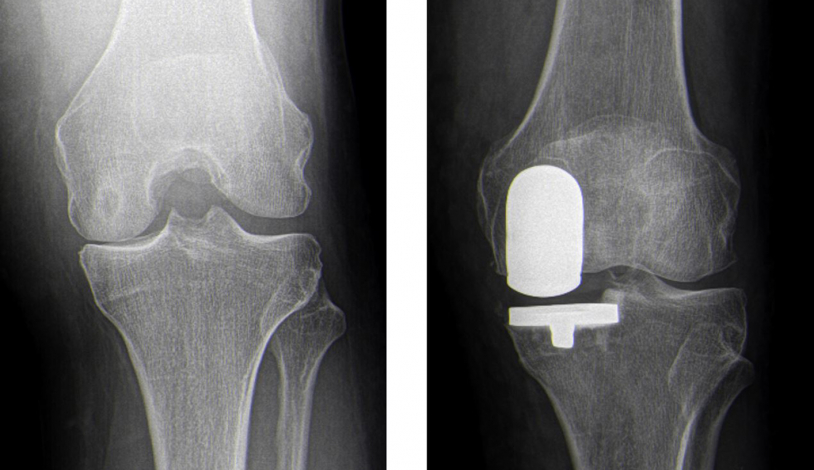 Knie Unikondiläre Schlittenprothese Knie Unikondiläre Schlittenprothese