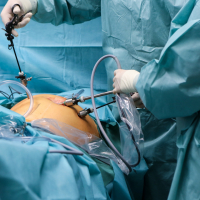 Operation im Bauchraum mit Trokaren