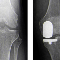 Knie Unikondiläre Schlittenprothese