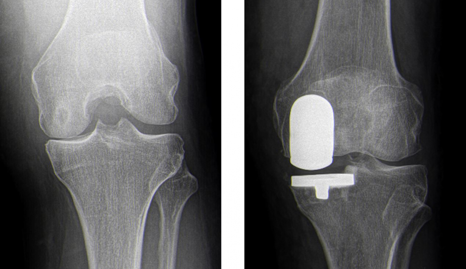 Knie Unikondiläre Schlittenprothese