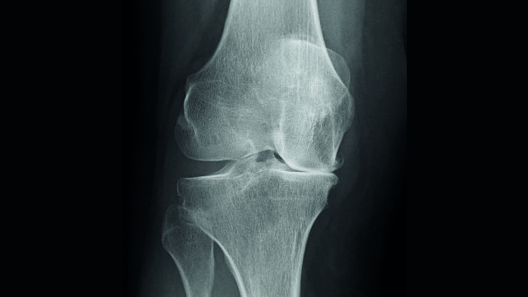 Roentgenbild Knie Web Roentgenbild Knie Web